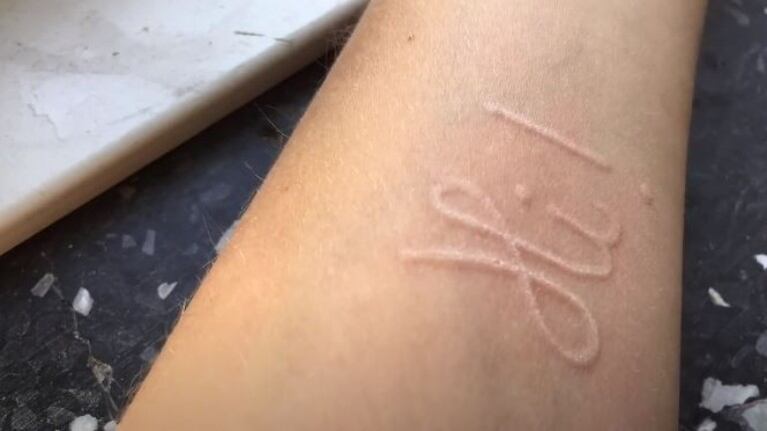 La rara afección cutánea de esta joven la convierte en un lienzo humano