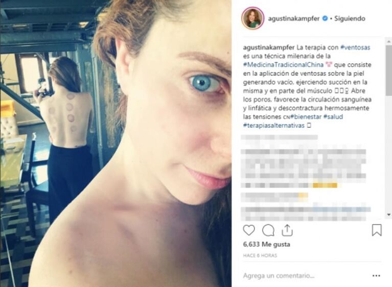 La revolucionaria técnica milenaria que utiliza Agustina Kämpfer para sentirse bien: "Terapia con ventosas"