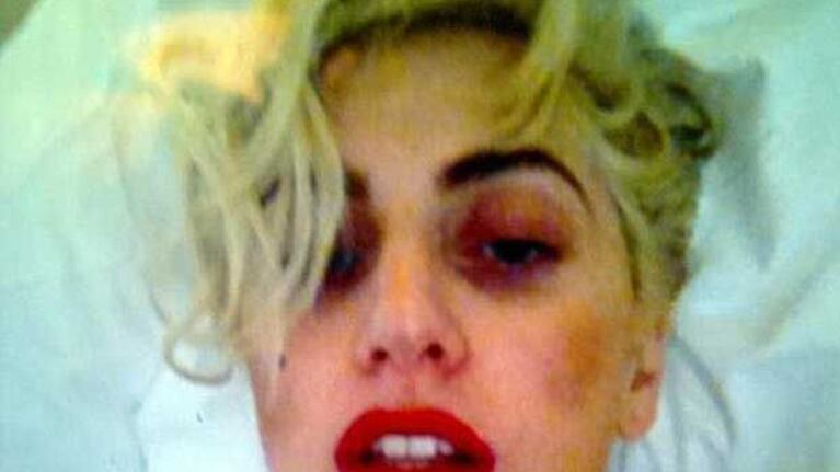 Lady Gaga con moretones, así quedó después del golpe en el show de Nueva Zelanda. (Foto: Web)