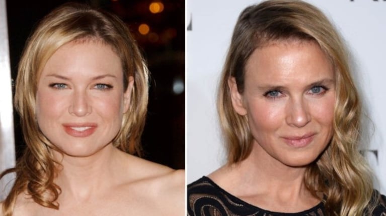Las cirugías de Renée Zellweger: ¿errores o aciertos?