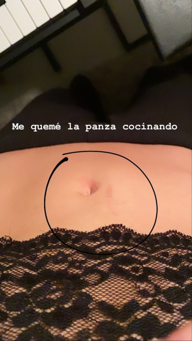 Las fotos del insólito accidente doméstico de Laurita Fernández en cuarentena: "Me quemé la panza"