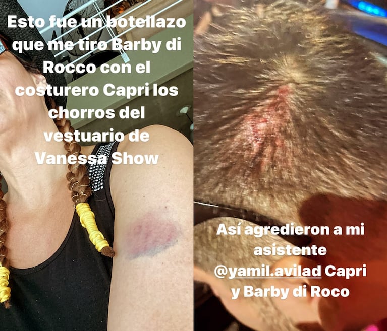 Las imágenes que compartió Oriana Junco para mostrar las heridas que le quedaron de la agresión que sufrió ella y su representante en un boliche de Palermo. (Foto: Instagram / orianajunco)