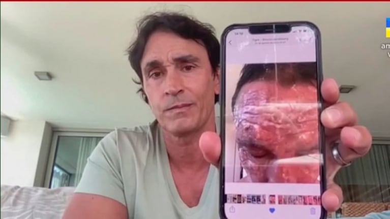 Las impactantes fotos del rostro quemado de Sebastián Estevanez en carne viva, tras el accidente con un bidón de alcohol: "Quiero concientizar"