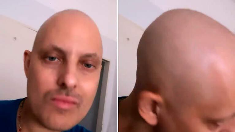 Lío Pecoraro publicó un mensaje esperanzador en su lucha contra la leucemia: “Pelito creciendo”