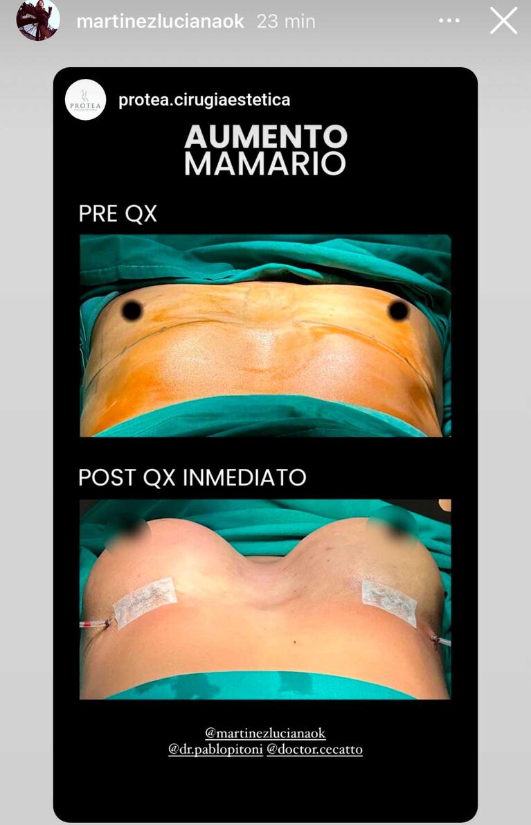 Luciana Martínez mostró el resultado de su cirugía (Foto: Instagram @martinezlucianaok)