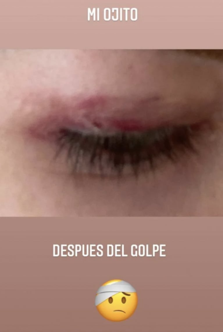 Luciana Salazar mostró las secuelas del golpe que se dio en un ensayo de La Academia: "Así amaneció mi ojito"