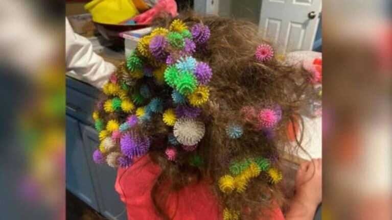 Madre tardó 20 horas en quitarle 150 juguetes que su hija se había enganchado en el pelo
