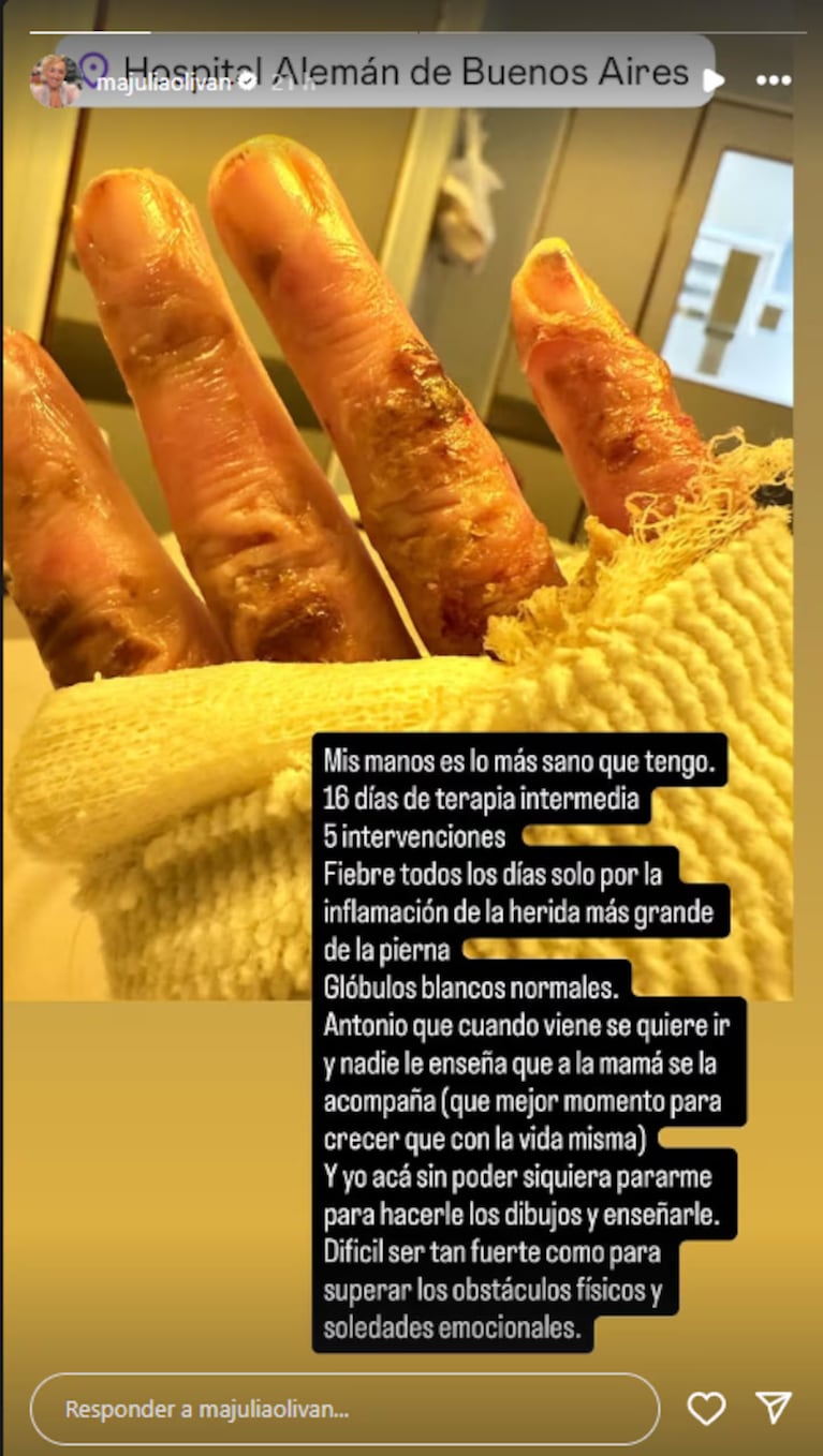 María Julia Oliván mostró las secuelas de su accidente. Crédito: Instagram/@majuliaolivan