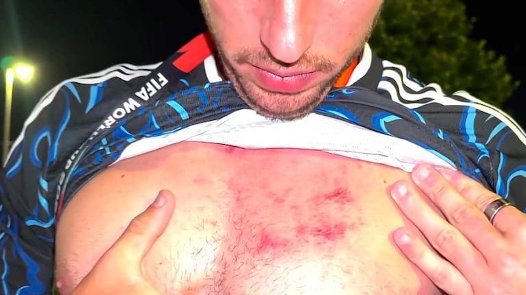 Martín Salwe mostró sus heridas en Infama (Foto: captura América TV)