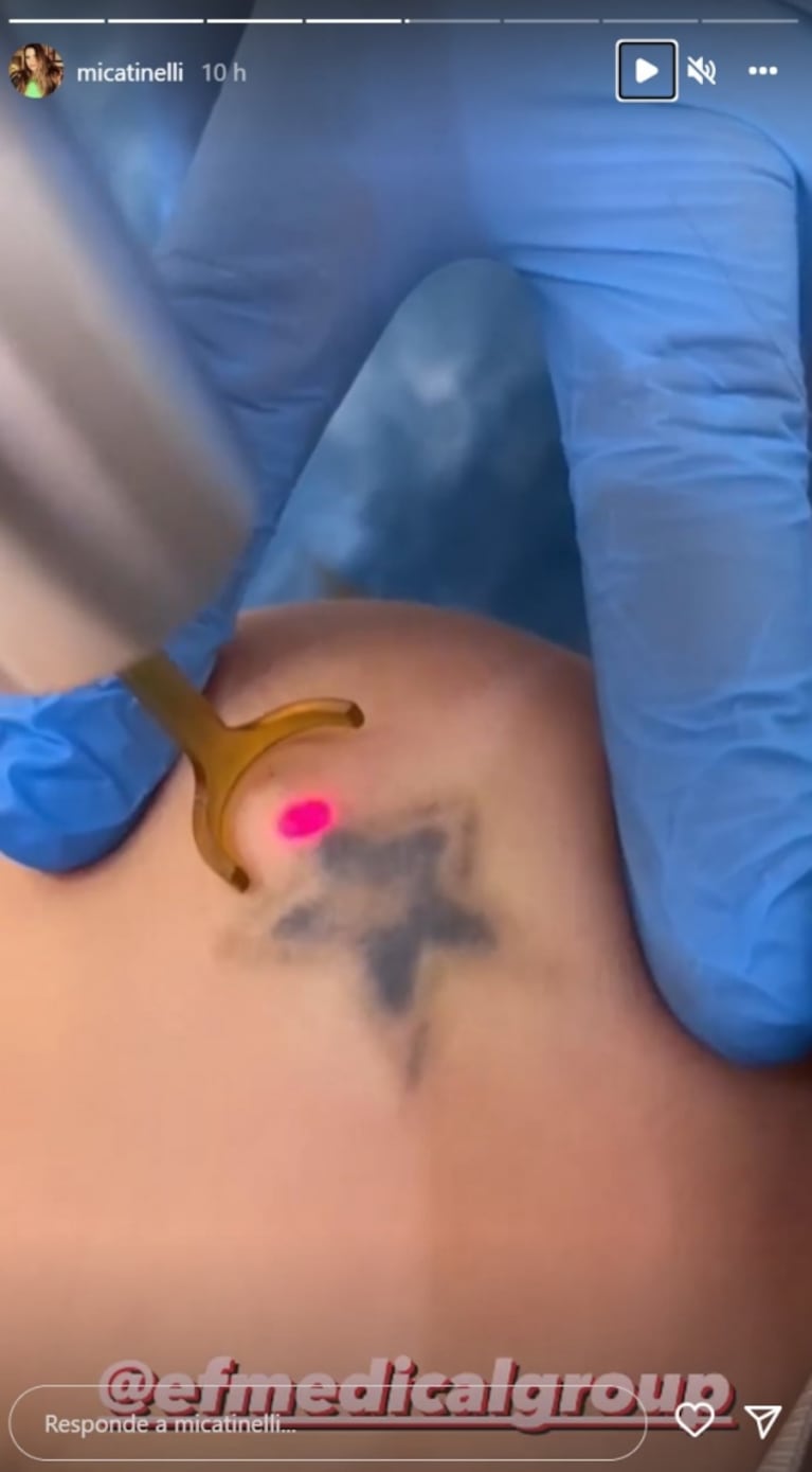 Mica Tinelli se remueve los tatuajes: cómo es el tratamiento