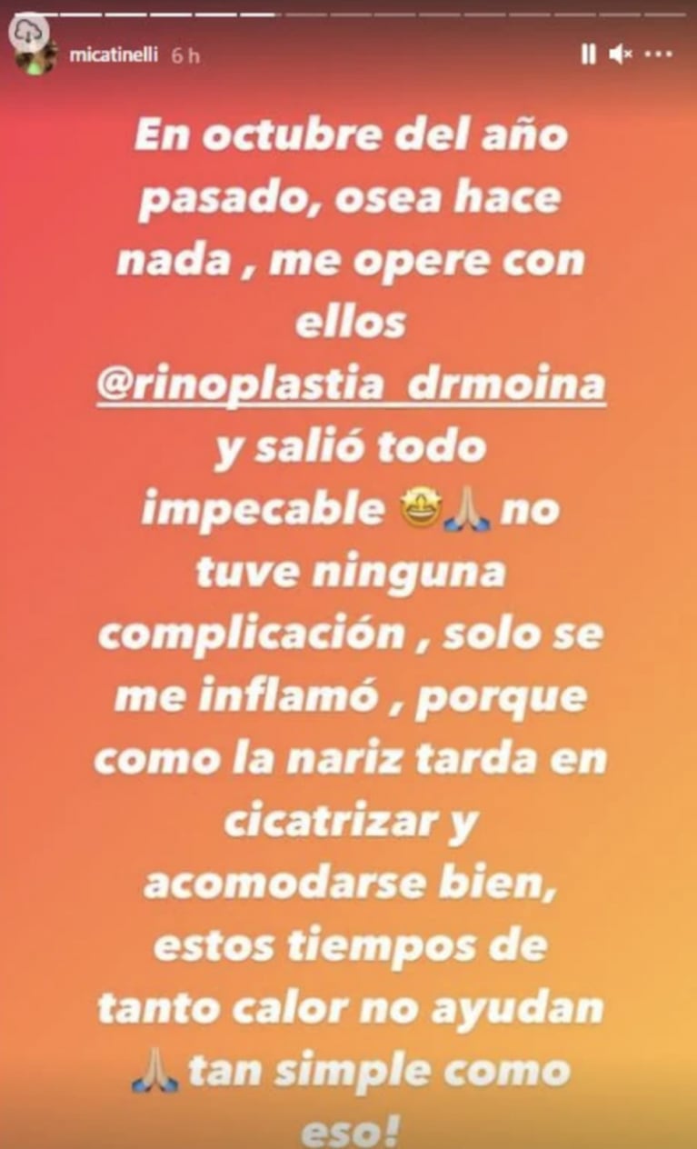 Micaela Tinelli explicó por qué se le inflamó la nariz tras su cirugía y mostró cómo le quedó: "Estos tiempos de calor no ayudan"