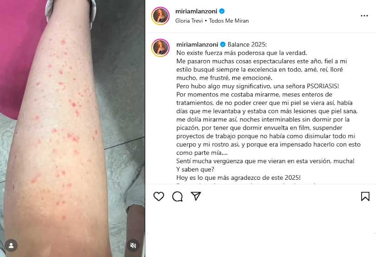 Miriam Lazoni mostró cómo la afectó la psoriasis (Foto: Instagram @miriamlanzoni)