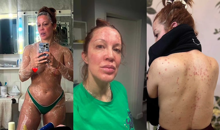 Miriam Lazoni mostró cómo la afectó la psoriasis (Fotos: Instagram @miriamlanzoni)