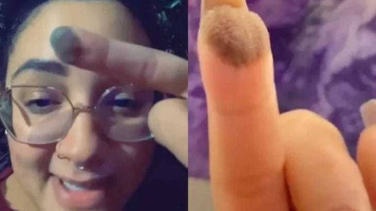 Mujer muestra en TikTok cómo le crece vello en su dedo tras un implante de piel