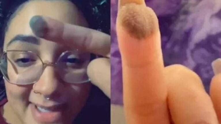 Mujer muestra en TikTok cómo le crece vello en su dedo tras un implante de piel