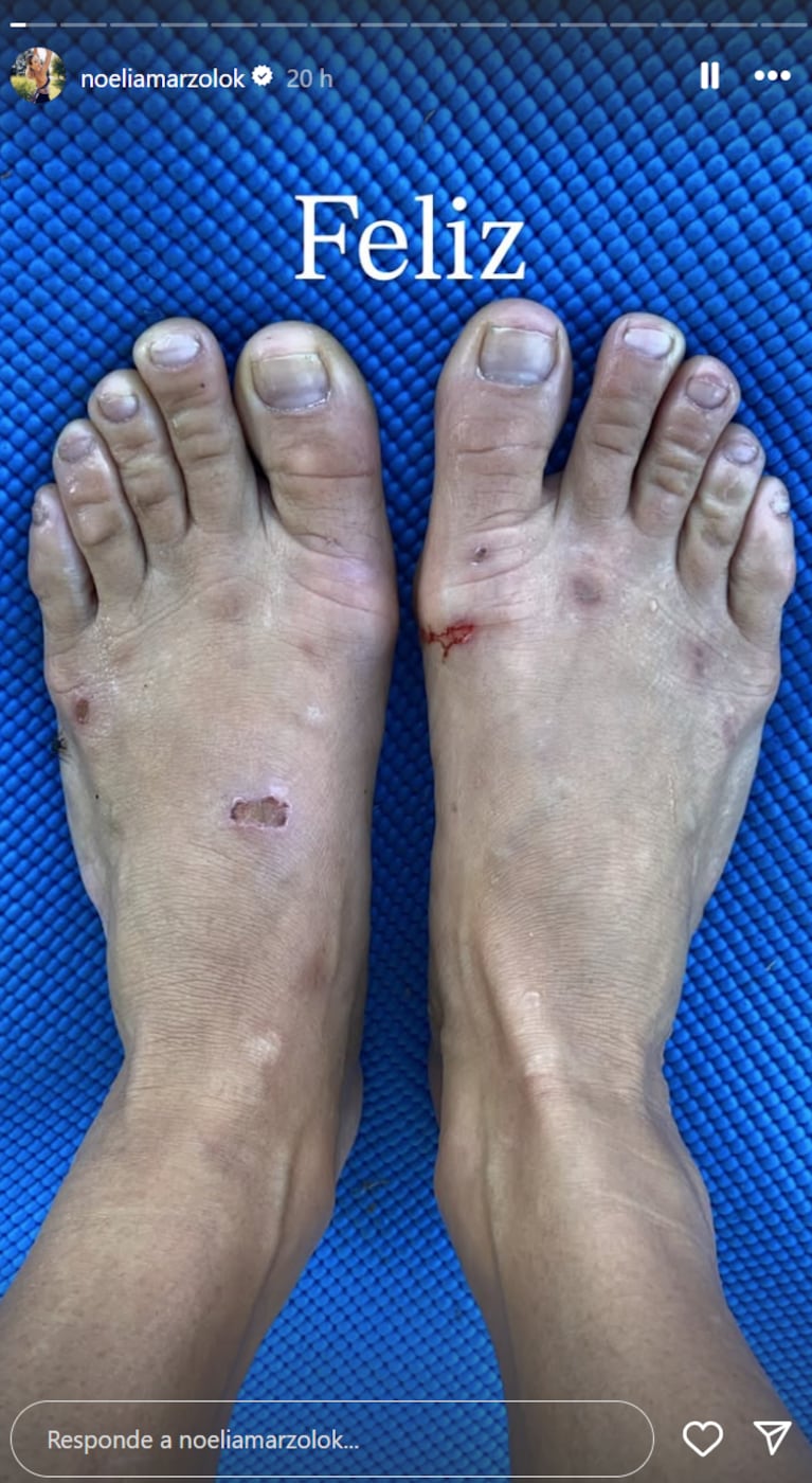 Noelia Marzol mostró sus lesiones por la danza. Foto: IG | noeliamarzolok