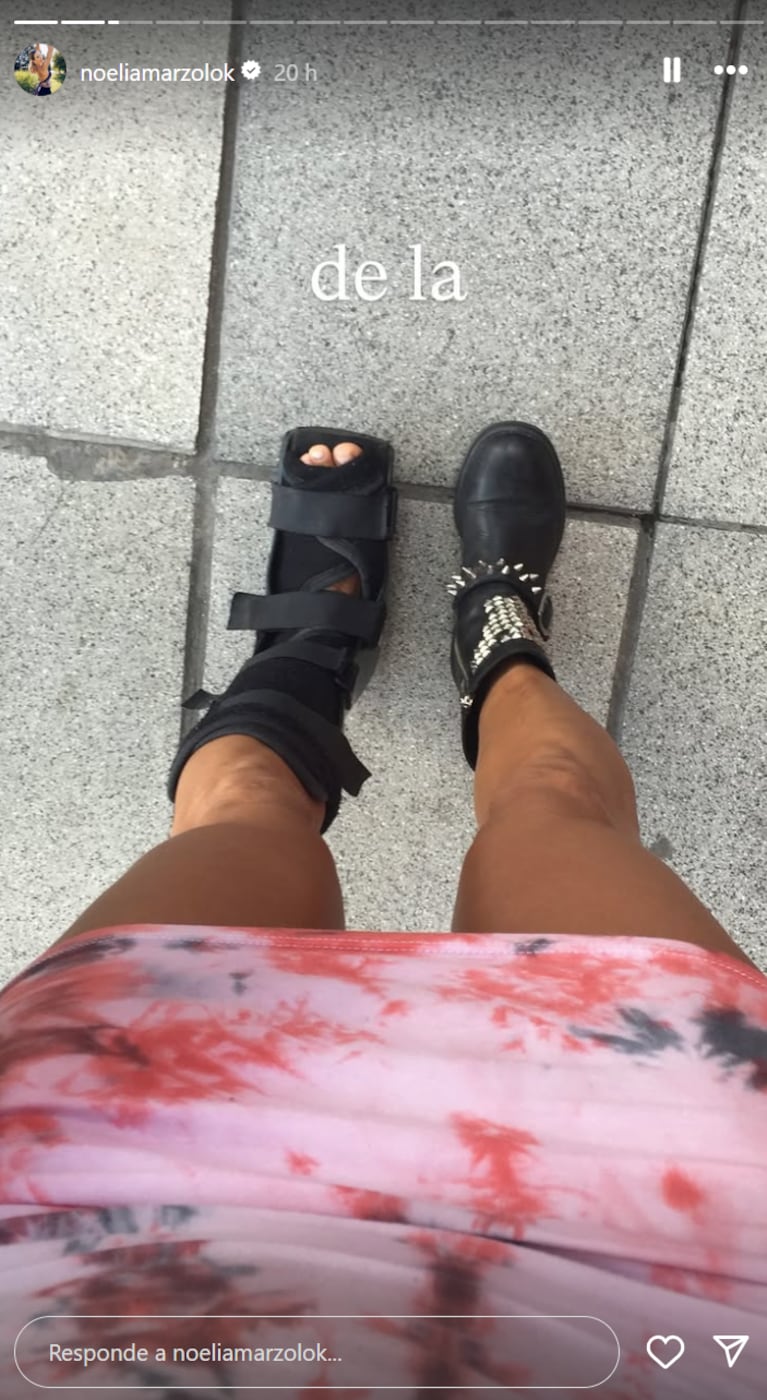 Noelia Marzol mostró sus lesiones por la danza. Foto: IG | noeliamarzolok
