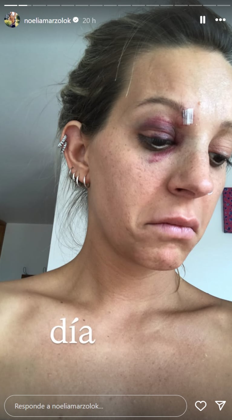 Noelia Marzol mostró sus lesiones por la danza. Foto: IG | noeliamarzolok