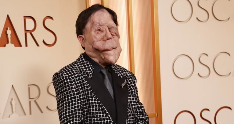 Premios Oscars 2026: quién es Adam Pearson, el actor con neurofibromatosis que genera conciencia sobre su enfermedad | Créditos: Instagram @adampearson