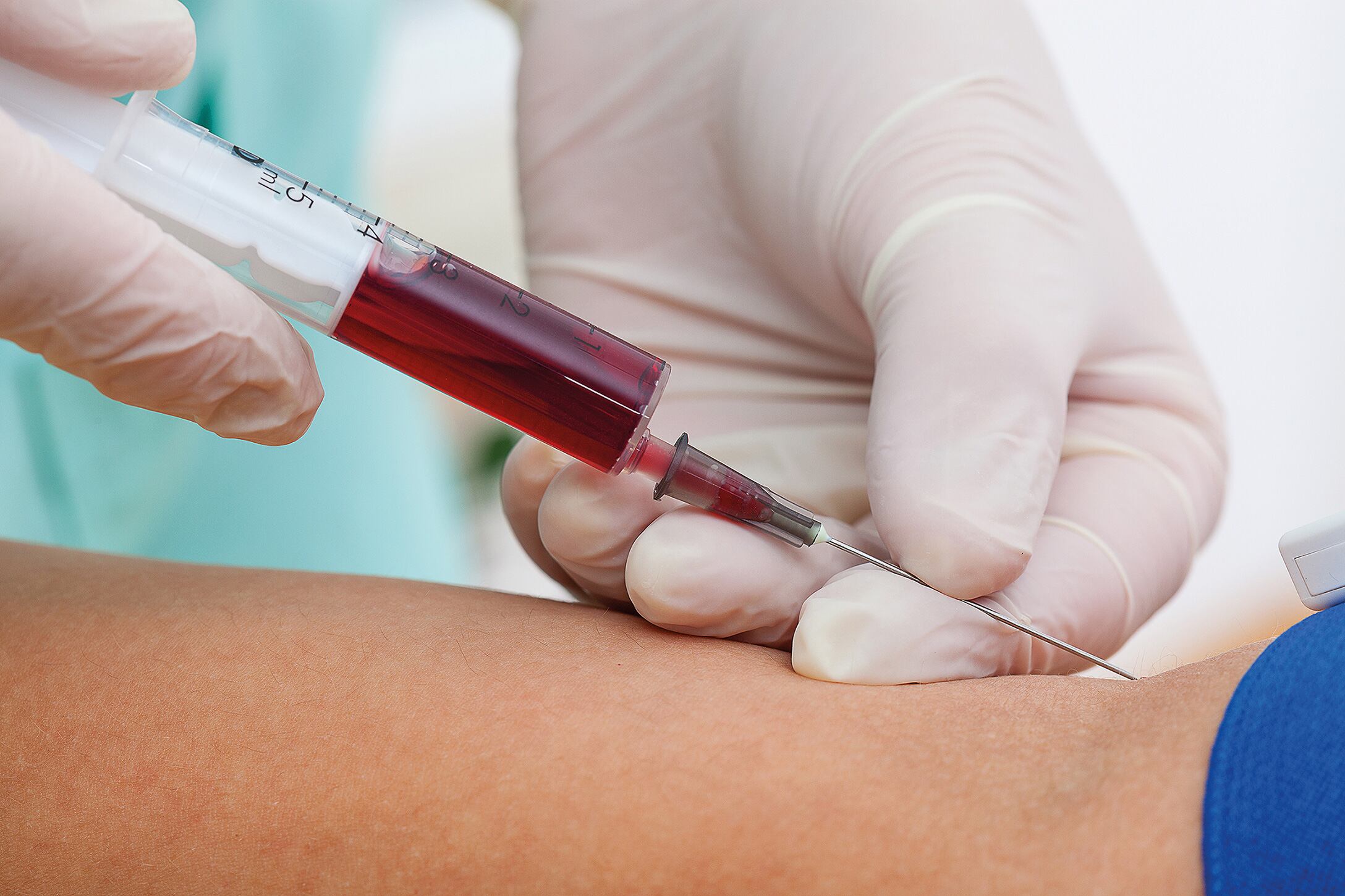 Prueba de sangre evalúa lesiones cerebrales traumáticas leves
