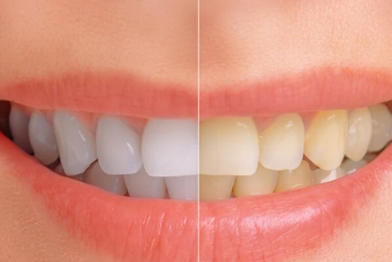¿Quéres dientes más blancos? Descubrí los productos que podés utilizar en casa