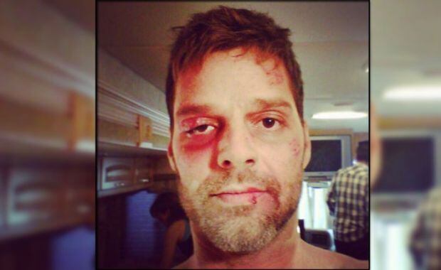Ricky Martin y en una impactante foto en Twitter con su rostro golpeado. (Foto: Instagram) 
