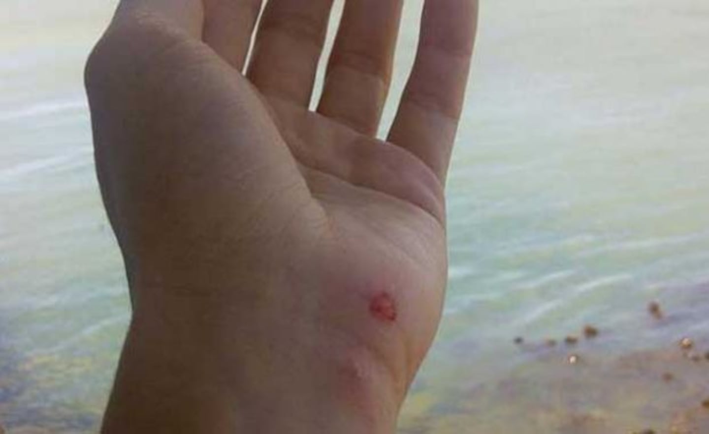 Shakira, atacada por un lobo marino en plenas vacaciones. (Foto: Facebook Shakira)