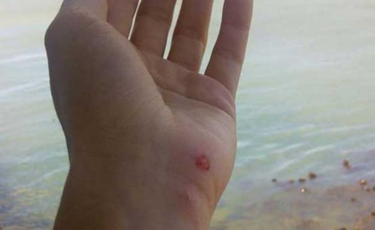 Shakira, atacada por un lobo marino en plenas vacaciones. (Foto: Facebook Shakira)