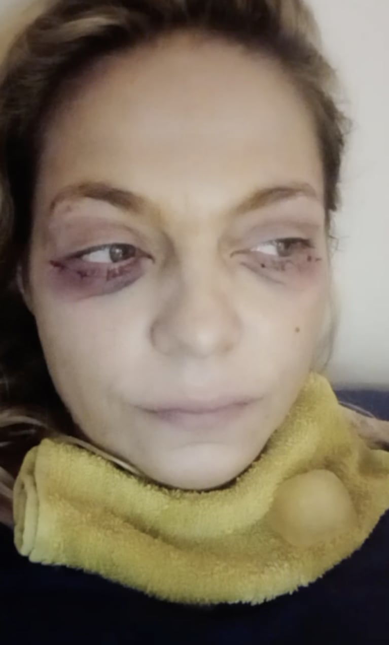 Tamara Paganini se mostró con los ojos con moretones y explicó el motivo: "Me saqué las bolsas"