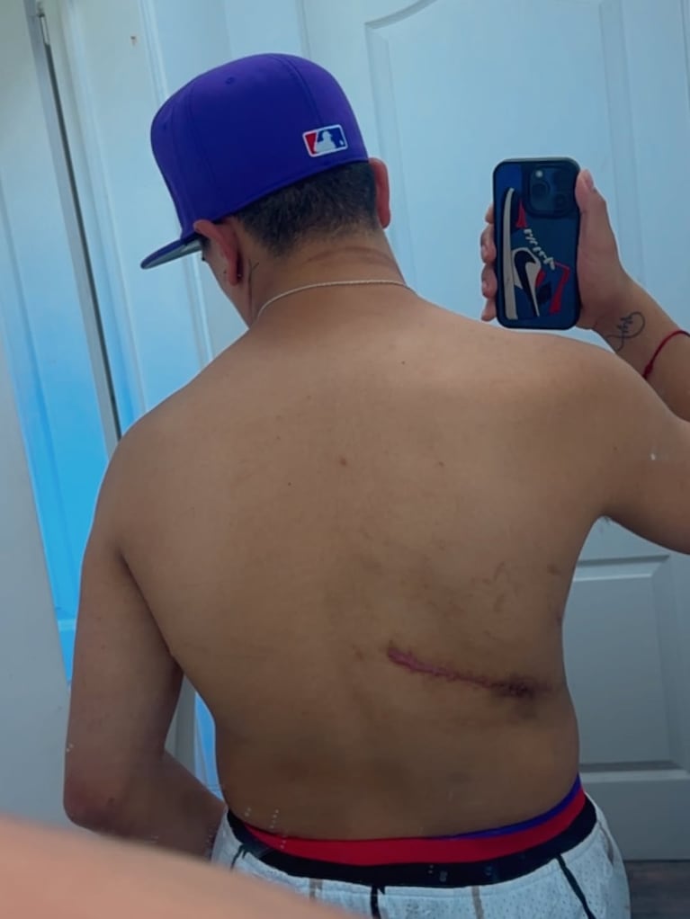 Thiago Medina mostró las cicatrices que le quedaron tras salvarse la vida. (Foto: @thi4go_km)