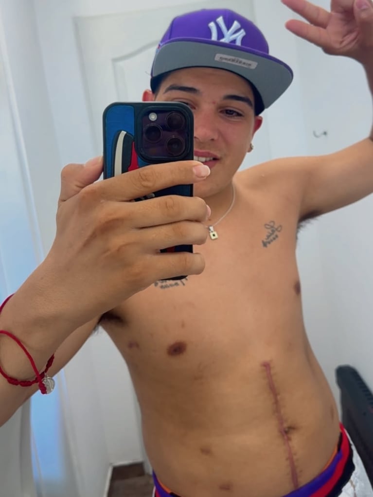 Thiago Medina mostró las cicatrices que le quedaron tras salvarse la vida. (Foto: @thi4go_km)