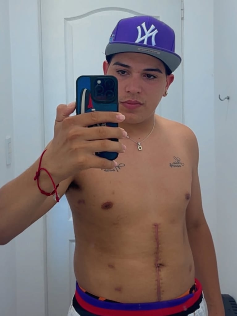 Thiago Medina mostró las cicatrices que le quedaron tras salvarse la vida. (Foto: @thi4go_km)