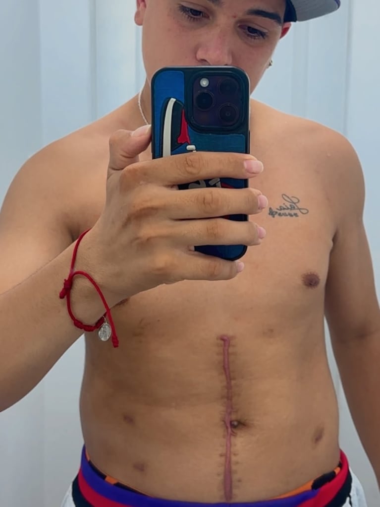 Thiago Medina mostró las cicatrices que le quedaron tras salvarse la vida. (Foto: @thi4go_km)