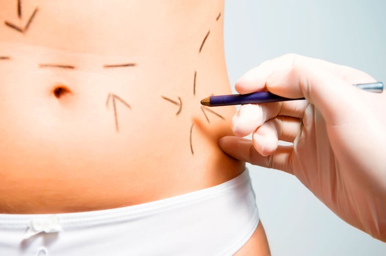 Todo lo que necesitás saber sobre la abdominoplastia