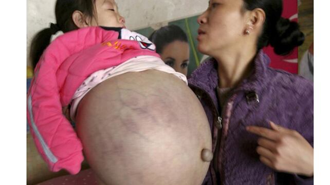 Una niña tiene un abdomen de más de un metro 
