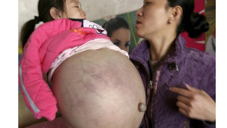 Una niña tiene un abdomen de más de un metro 