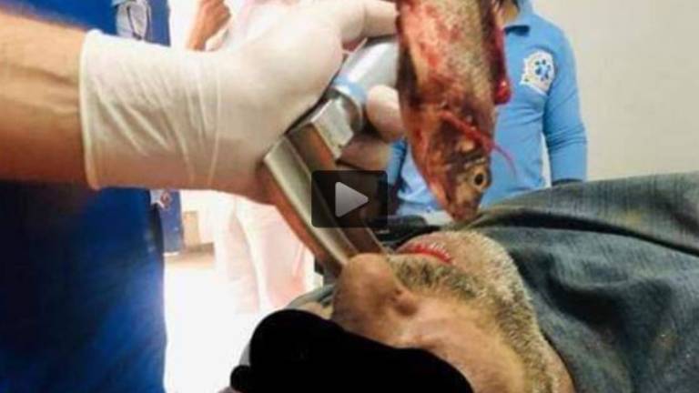 Video: le extrajeron un pez vivo de la garganta a un pescador