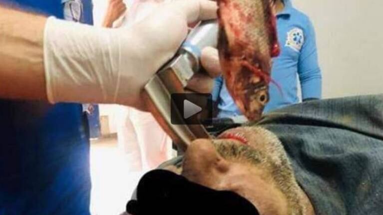 Video: le extrajeron un pez vivo de la garganta a un pescador