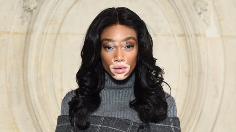 Winnie Harlow fue acosada de niña por tener vitíligo