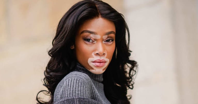 Winnie Harlow fue descubierta a través de Instagram