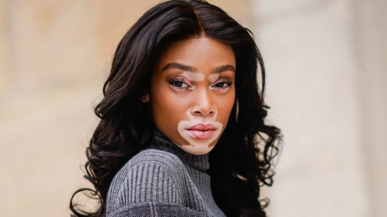 Winnie Harlow fue descubierta a través de Instagram