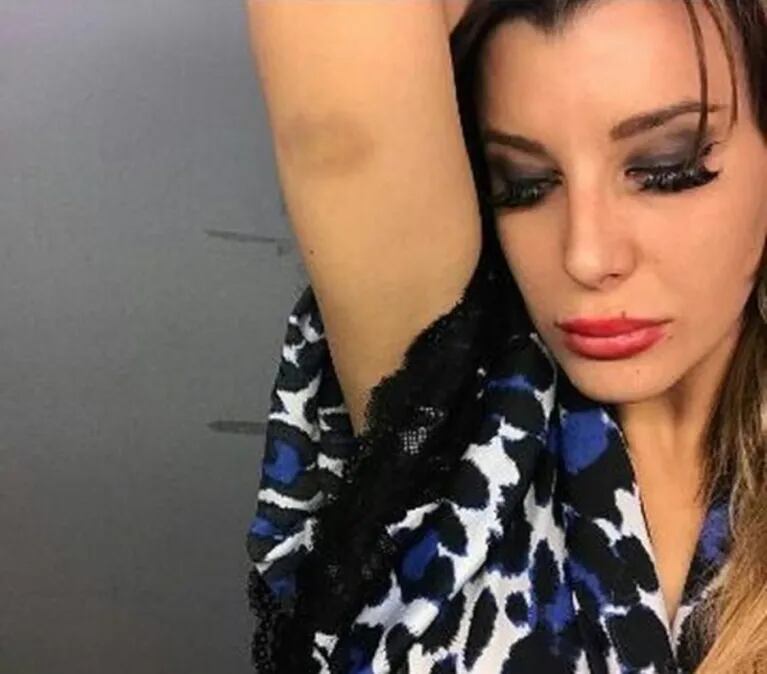Luego de negar haber sido golpeada por Loan, Charlotte Caniggia publicó una foto con un moretón en el brazo… y la borró 